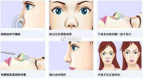 疤痕|隆鼻后疤痕增生怎么办？如何解决隆鼻疤痕呢？