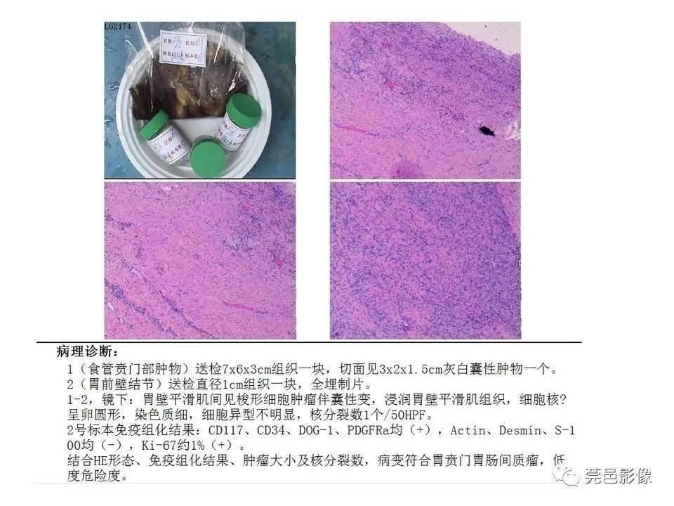 畸形|胃重复畸形CT诊断与鉴别诊断