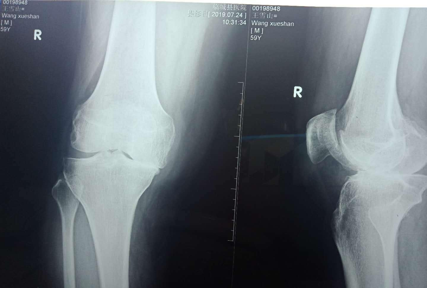 骨质增生|骨质增生让人花了多少冤枉钱