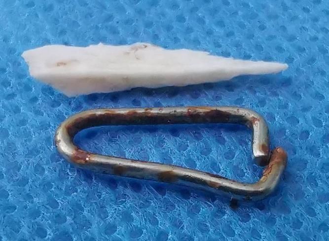  面汤|喂7个月大幼儿喝面汤，竟让这个东西卡进气管！