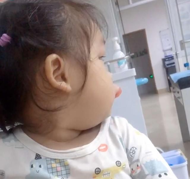 嘴巴|女儿吃芒果过敏,嘴巴2小时就肿成了“鸭子嘴”,亲妈笑出鹅叫声