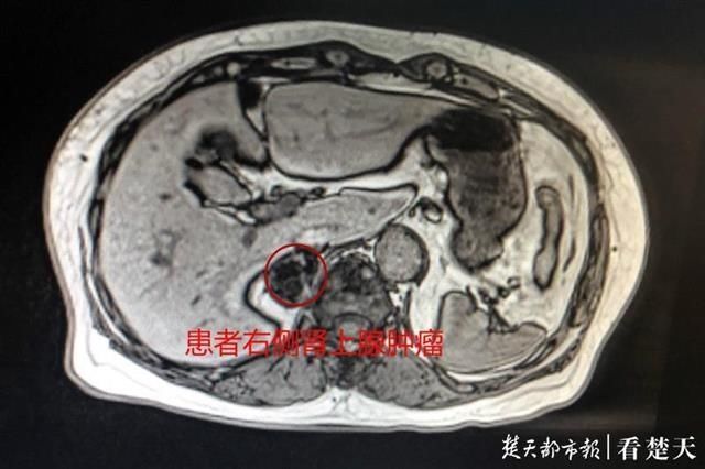  异常|常规体检发现“意外瘤”，医生拆“沉默炸弹”