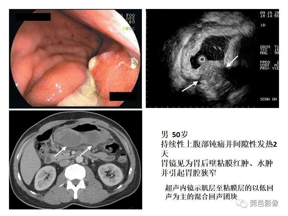 畸形|胃重复畸形CT诊断与鉴别诊断