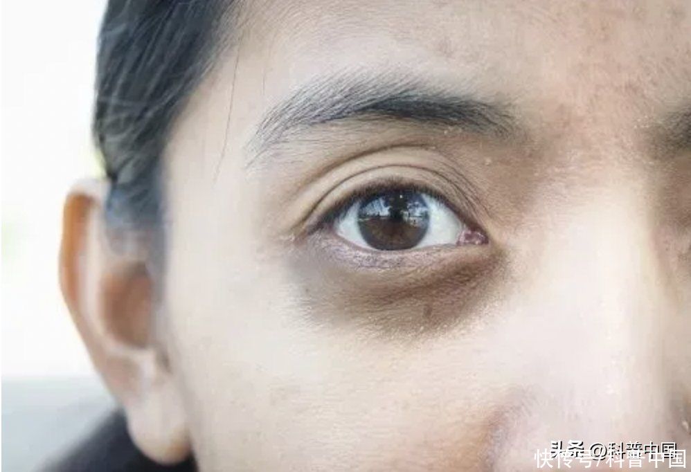 黑眼圈一定是熬夜造成的吗(黑眼圈一定是熬夜造成的吗？这几种情况，千万别忽视！)