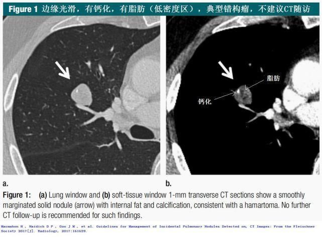  结节|肺结节切还是不切？20张经典图谱说明白了！