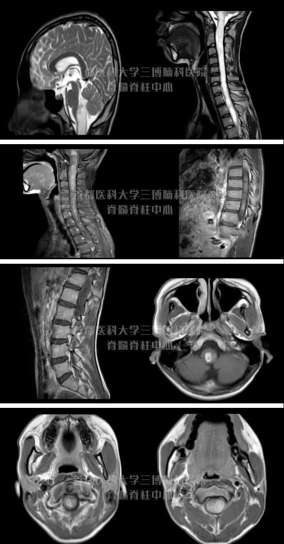 脊髓|非常罕见 15岁初中生莫名肢体无力 脊髓内竟然长满肿瘤