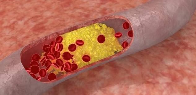  二黄|血液粘稠，多吃二黄，常喝二水，学会三个动作，血管不堵人长寿！
