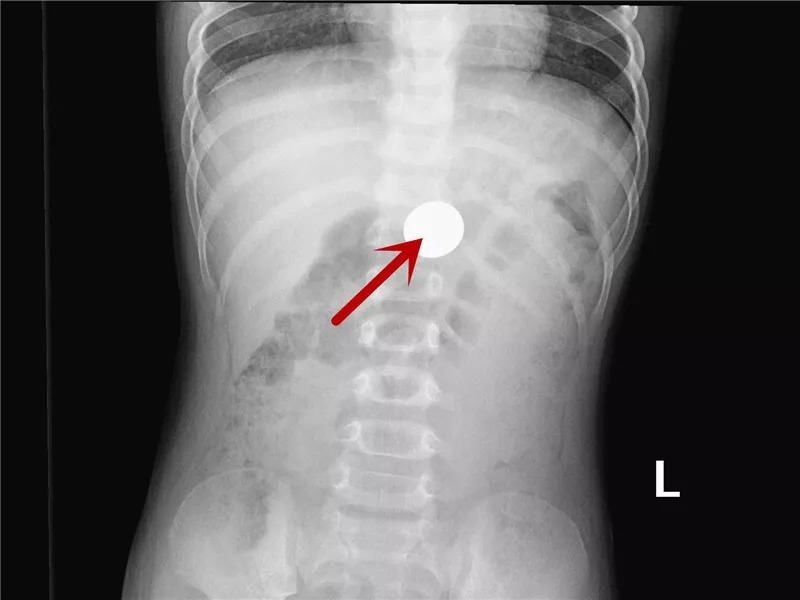  真相|有图有真相：那些年，孩子体内发现的硬币、钥匙、钉子、别针、电池……