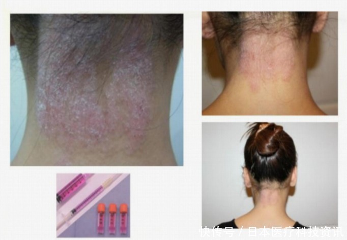  治疗|日本最先端保养品，干细胞上清液！