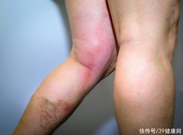 血栓来临手脚先知的四个症状(血栓来临，手脚先知！提醒：手脚出现4种表现，或提示你血管堵了)