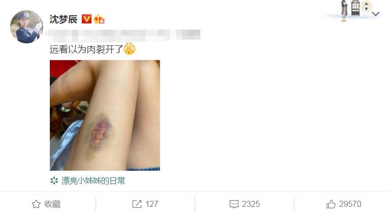 吃醋|沈梦辰晒大腿伤痕,第一个回复的却不是男友,不怕杜海涛吃醋吗?