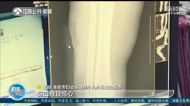  男童|好危险！两岁男童误启电动车 翻车缝了近60针