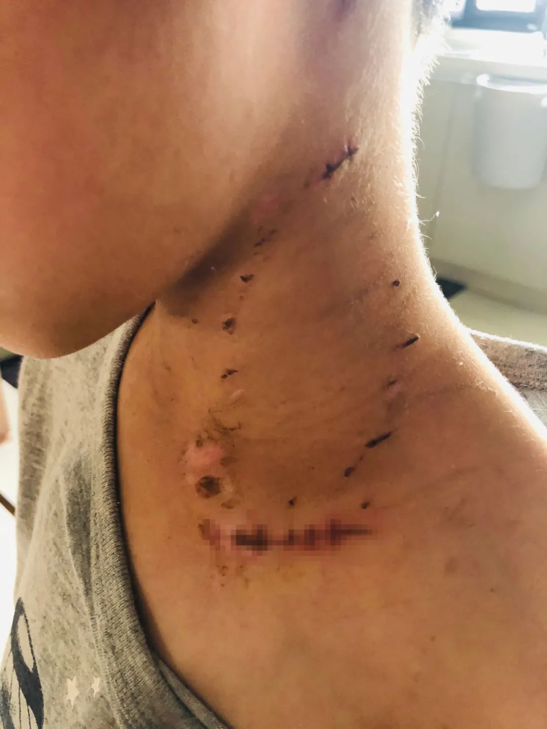  咬住|6岁男孩小区内被狗一口咬住喉咙……事发大连