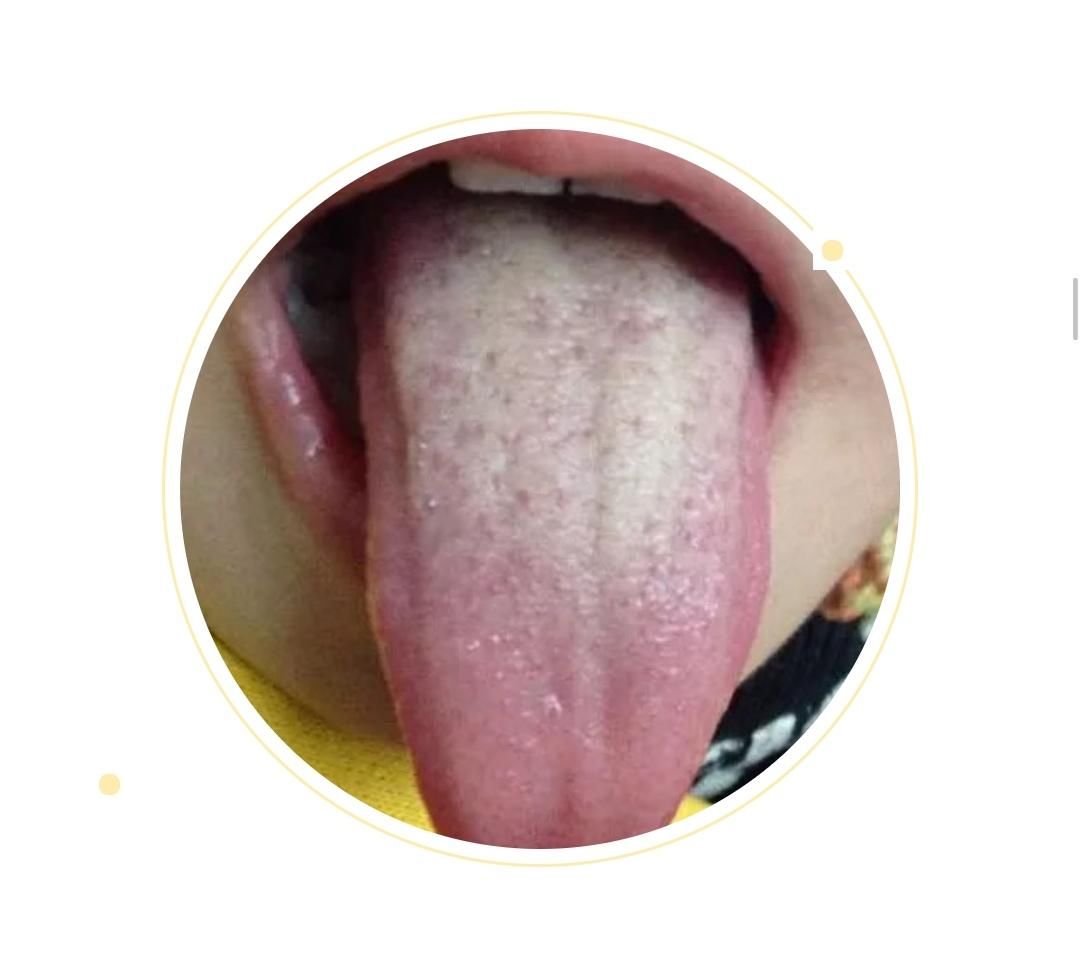  变化|身体健康情况怎么样？可以从舌头进行窥探