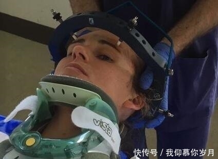 杰佛利|女子6年前因打喷嚏导致颈椎骨断裂,悲催的是最近一笑又断了!